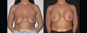 Breast Augmentation before and after photos