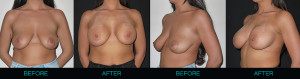 Breast Augmentation before and after photos